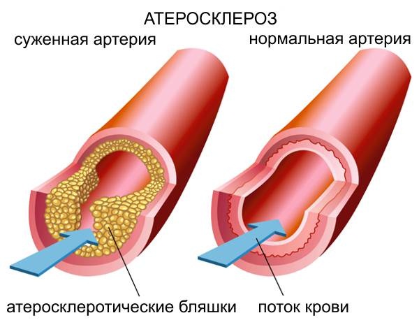 Гомоцистеин - что это, анализ при планировании беременности. Что показывает, норма, как сдавать кровь