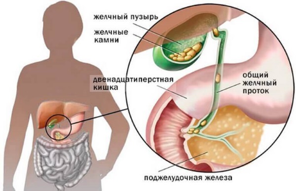 Симптомы и лечение холецистита. Народные средства, лекарства, диета, антибиотики, травы. Клинические рекомендации