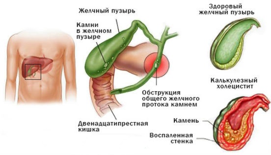 Симптомы и лечение холецистита. Народные средства, лекарства, диета, антибиотики, травы. Клинические рекомендации