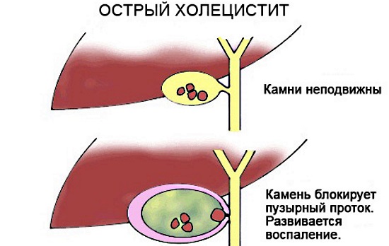 Острый холецистит. Симптомы и лечение, причины у взрослых