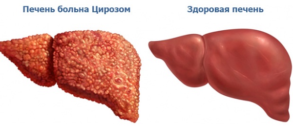 Преднизолон. Инструкция по применению в таблетках, ампулах, мазь. Цена, аналоги