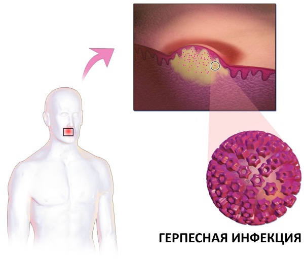 Как начинается ветрянка у детей, первые признаки, симптомы и лечение, инкубационный период