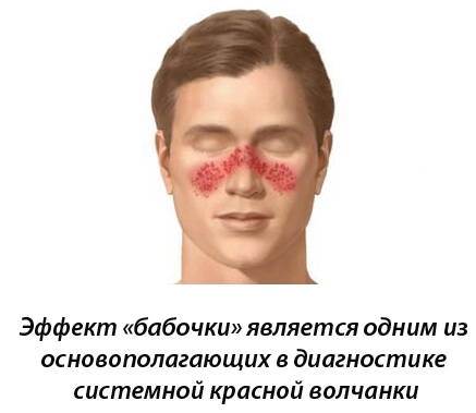 Красная волчанка. Что это за болезнь, симптомы, причины. Как передается, лечение