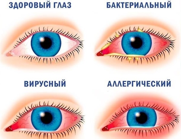 Красный глаз у ребенка. Причины с гноем и без, чешется. Лечение, промывание чаем