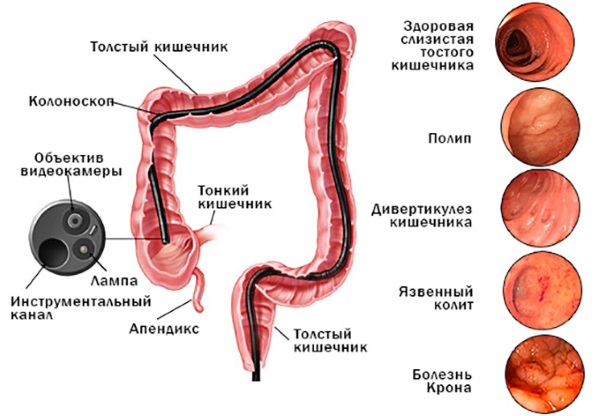 Ректороманоскопия кишечника. Что это такое, подготовка, как делается обследование у женщин, мужчин, чем лучше колоноскопии