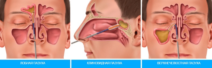 Риносинусит. Симптомы и лечение у взрослых, детей: острый, хронический, полипозный, гнойный, катаральный