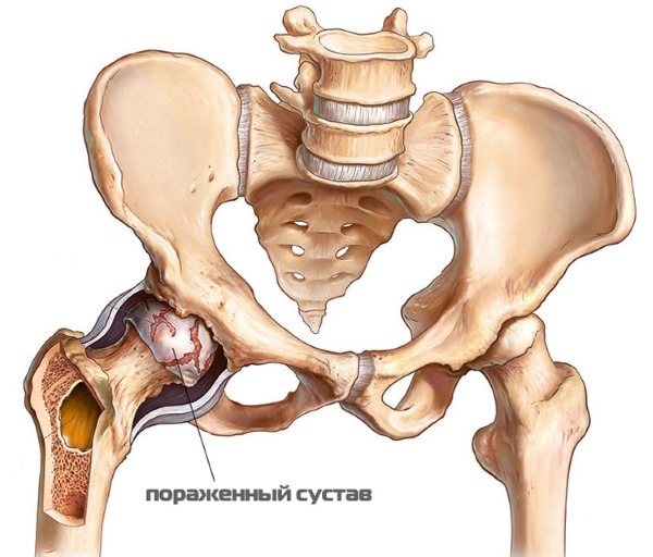 Артрит тазобедренного сустава. Симптомы и лечение у пожилых, детей. Препараты, народные средства
