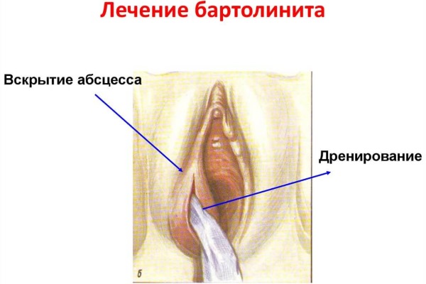 Бартолинит у женщин. Симптомы и лечение, стадии, антибиотики, мази, операция