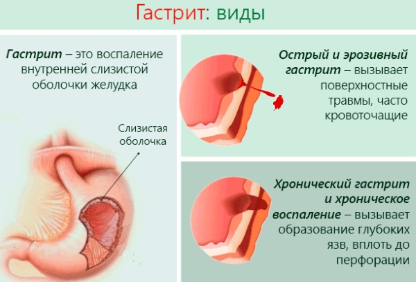 Боль в левом боку на уровне талии со спины, спереди, сбоку у женщин. Причины, лечение