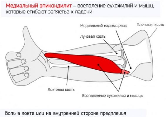 Латеральный эпикондилит фото