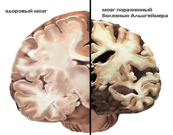Альцгеймера болезнь симптомы первые признаки у женщин пожилого возраста продолжительность жизни фото