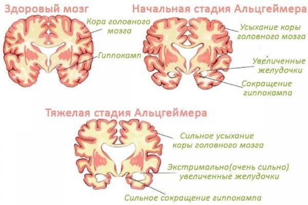 Невролог и невропатолог: разница, отличие, что лечит