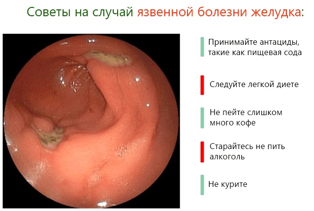 Боли в желудке после еды. Причины, лечение. Диета, лекарства, народные средства