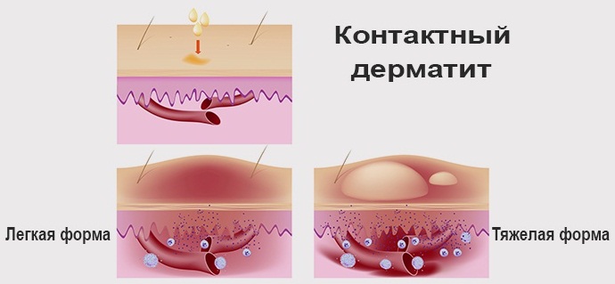 Димексид. Инструкция по применению раствор, компресс, гель. Цена, аналоги, отзывы