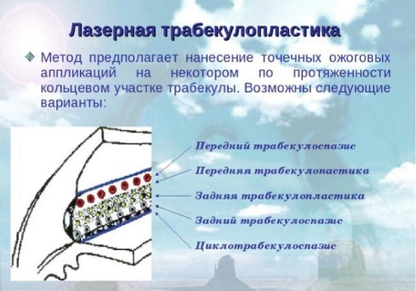 Глаукома. Причины, симптомы, лечение. Препараты, народные средства