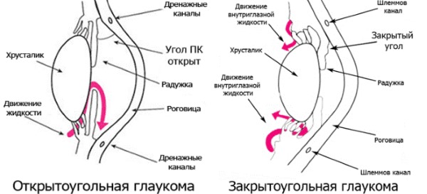 Глаукома. Причины, симптомы, лечение. Препараты, народные средства