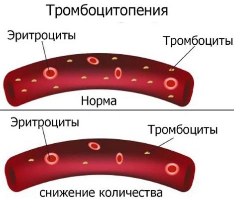 Мононуклеоз клиническая картина