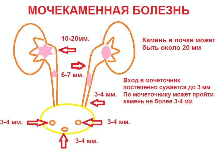 Камни в мочевом пузыре. Симптомы у женщин, причины, лечение народными средствами, таблетками, лазером