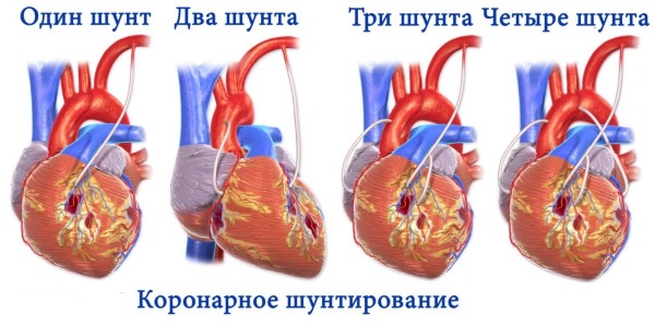 Кардиосклероз. Что это такое, как лечить, симптомы, народные средства, препараты