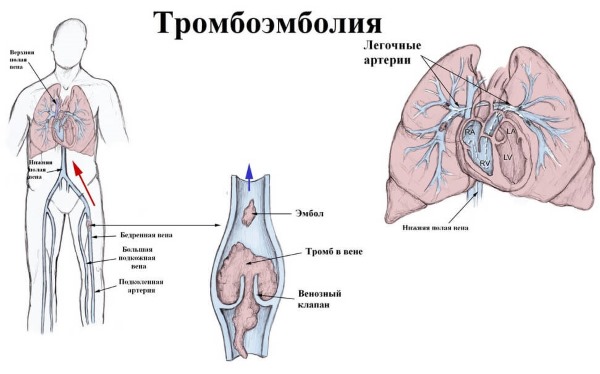 Кардиосклероз. Что это такое, как лечить, симптомы, народные средства, препараты