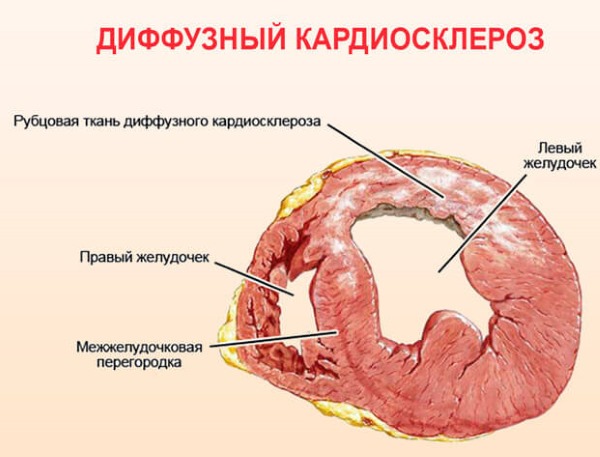 Кардиосклероз. Что это такое, как лечить, симптомы, народные средства, препараты