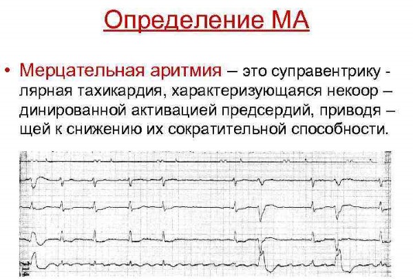 Кардиосклероз. Что это такое, как лечить, симптомы, народные средства, препараты