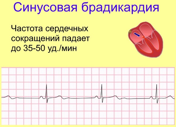 Кардиосклероз. Что это такое, как лечить, симптомы, народные средства, препараты