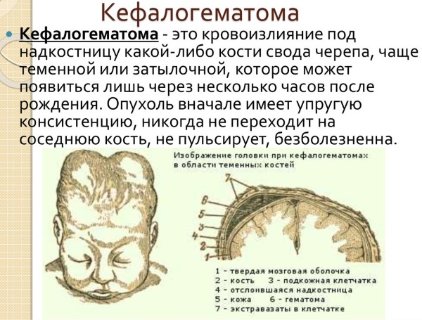 Кефалогематома на голове у новорожденного. Последствия, причины, лечение, реабилитация