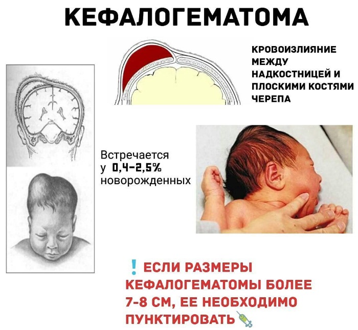 Кефалогематома на голове у новорожденного. Последствия, причины, лечение, реабилитация