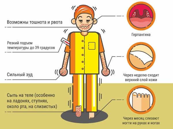 Вирус Коксаки у детей. Симптомы, чем лечить, инкубационный период