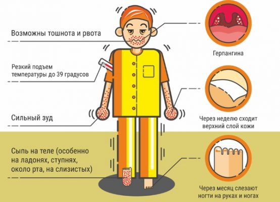 Картинки герпесной ангины