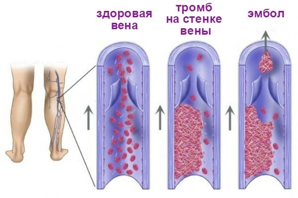 Менопаузальный синдром. Признаки, как наступает, виды, таблетки, витамины, как отсрочить