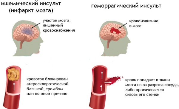 Мозговое кровообращение. Лечение, препараты, недорогие, но эффективные