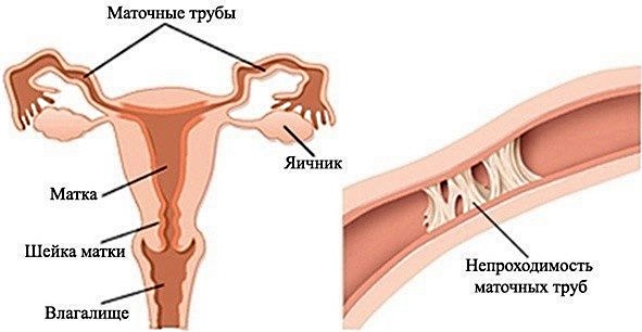 Нарушение менструационного цикла. Причины у подростков, женщин, после противозачаточных, родов, при грудном вскармливании