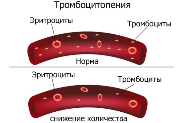 Низкий уровень тромбоцитов в крови. Причины у женщин, мужчин, детей. Чем грозит, что делать