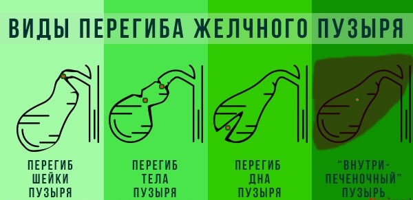 Перегиб желчного пузыря. Что это такое, симптомы и лечение, диета. Клинические рекомендации