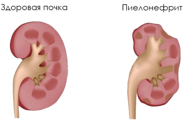 Пиелонефрит у женщин, при беременности, после родов. Симптомы, лечение, диета