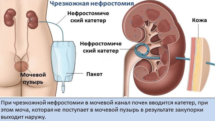 Пиелонефрит у женщин, при беременности, после родов. Симптомы, лечение, диета