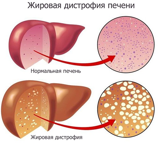 Признаки больной печени у женщины на коже, лице, симптомы, лечение