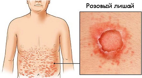 Розовый лишай у человека. Симптомы, лечение, причины возникновения у детей, взрослых. Народные средства, препараты, мази