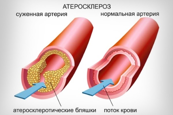 Розувастатин. Инструкция по применению. Цена, аналоги