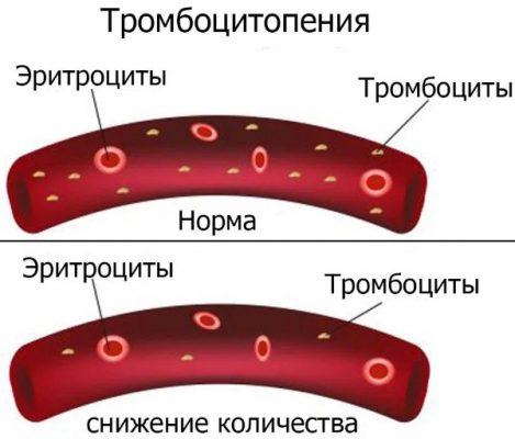 Появляются синяки на теле без причины в разных местах у женщин симптомы фото