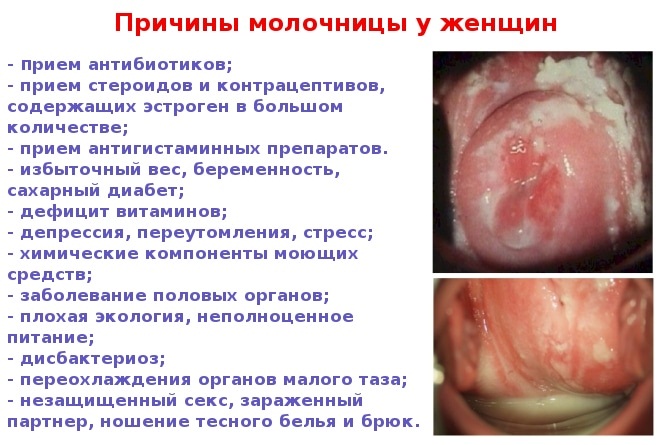 Средства от молочницы для женщин. Таблетки, лекарства, мази, свечи, крема, лечение народными средствами