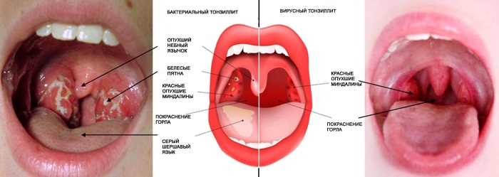 Эффективные спреи от боли в горле для детей и взрослых