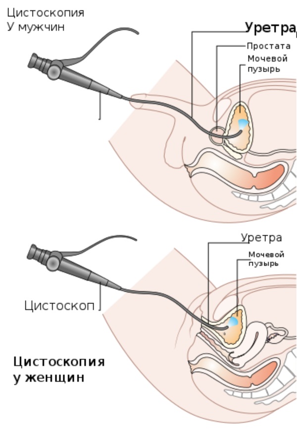 Цистоскопия мочевого пузыря у женщин, мужчин и детей. Описание процедуры, подготовка пациента, результаты обследования
