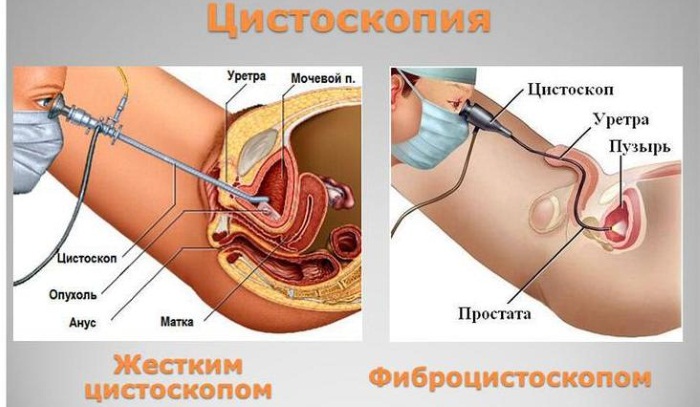 Цистоскопия мочевого пузыря у женщин, мужчин и детей. Описание процедуры, подготовка пациента, результаты обследования