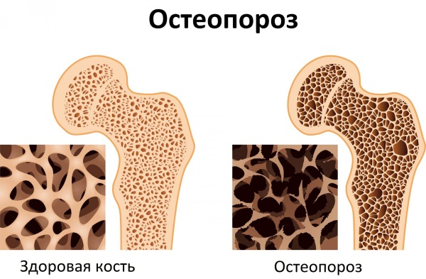 Вертебропластика позвоночника. Цена, реабилитация после операции