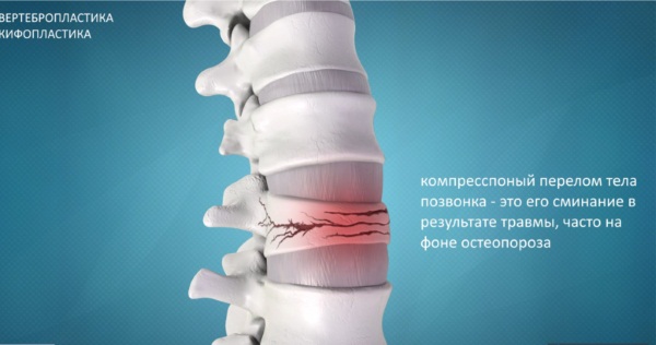 Вертебропластика позвоночника. Цена, реабилитация после операции