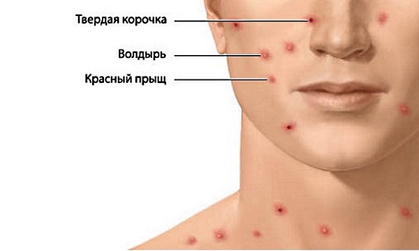 Ветрянка у взрослых. Симптомы и лечение, инкубационный период, стадии