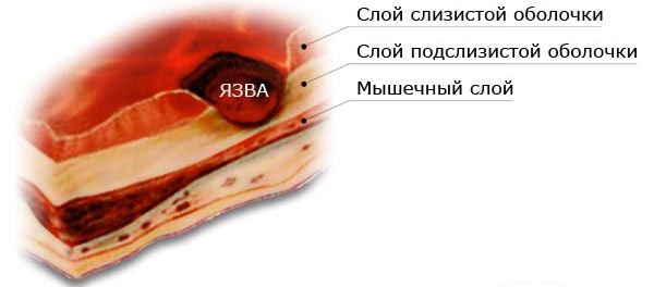 Язва двенадцатиперстной кишки. Симптомы и лечение, причины. Народные средства, диета, препараты